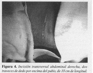 Incisión transversal Abdominal derecha