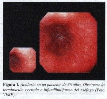 Acalasia en un Paciente de 36 años Acalasia en un Paciente de 36 años