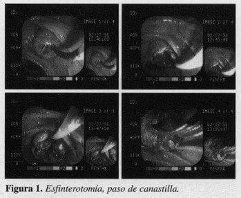 Esfinterotomía, paso de canastilla Esfinterotomía, paso de canastilla