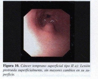 Cáncer temprano superficial tipo II Cáncer temprano superficial tipo II