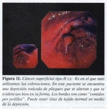 Cáncer superficial tipo II Cáncer superficial tipo II