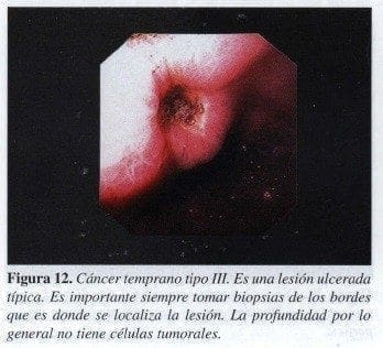 Cáncer temprano tipo IlI Cáncer temprano tipo IlI