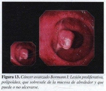 Cáncer avanzado Bormann 1 Cáncer avanzado Bormann 1
