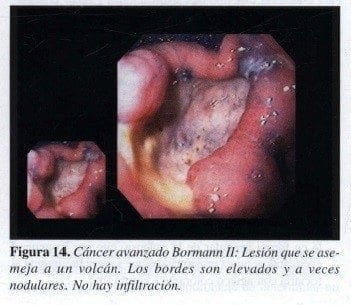 Cáncer avanzado Bormann II Cáncer avanzado Bormann II