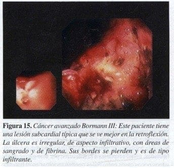 Cáncer avanzado Bormann III Cáncer avanzado Bormann III