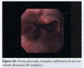 Forma ulcerada Forma ulcerada