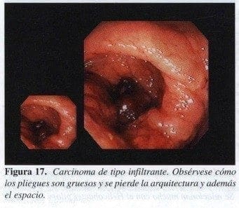 Carcinoma de tipo infiltrante Carcinoma de tipo infiltrante