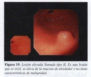 Lesión elevada Yamada tipo II Lesión elevada Yamada tipo II