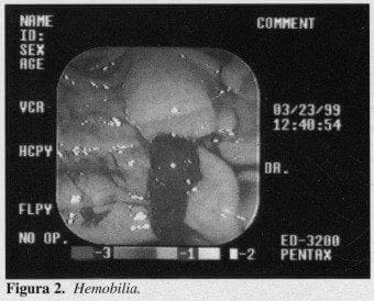 Hemobilia Hemobilia