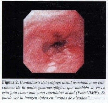 Candidiasis del Esófago Distal asociada a un Carcinoma de la Unión Gastroesofágica Candidiasis del Esófago Distal asociada a un Carcinoma de la Unión Gastroesofágica