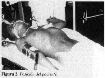 Esplenectomía Laparoscópica, Posición del paciente