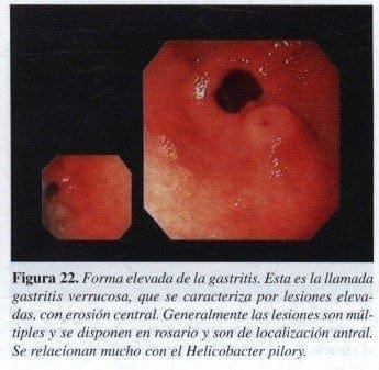 Forma elevada de la Gastritis Forma elevada de la Gastritis