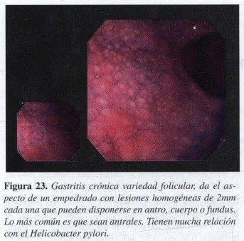 Gastritis Crónica variedad Folicular Gastritis Crónica variedad Folicular
