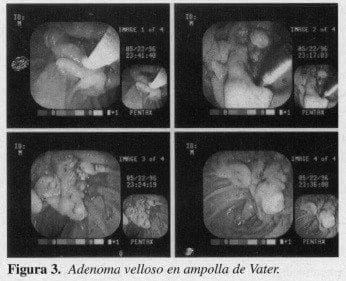 Adenoma velloso en ampolla de Vater Adenoma velloso en ampolla de Vater
