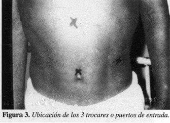 Esplenectomía Laparoscópica, Ubicación de los 3 trocares o puertos de entrada