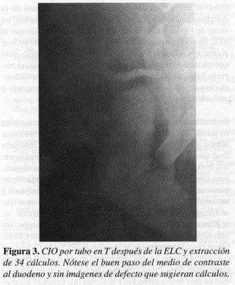 CIO por tubo en T después de la ELC CIO por tubo en T después de la ELC