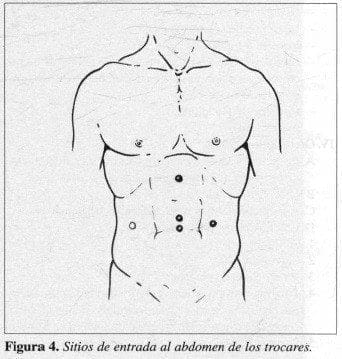 Sitios de entrada al Abdomen de los Trocares