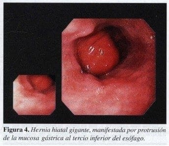 Hernia Hiatal Gigante Hernia Hiatal Gigante