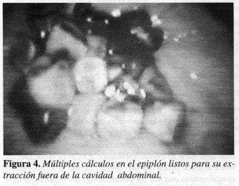 Múltiples cálculos en el Epiplón Listos Múltiples cálculos en el Epiplón Listos