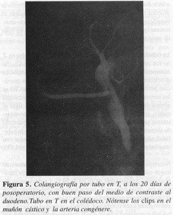 Colangiografía por tubo en T Colangiografía por tubo en T