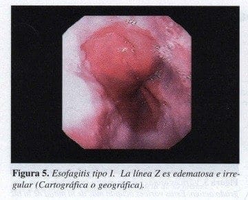 Esofagitis tipo I Esofagitis tipo I