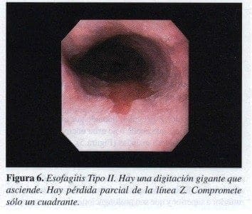 Esofagitis Tipo II Esofagitis Tipo II