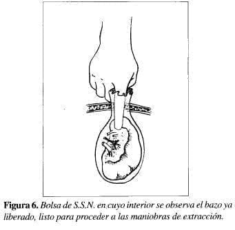 Bolsa de S.S.N. en,cuyo interior se observa el bazo ya liberado