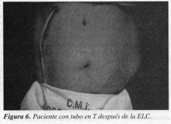 Paciente con tubo en T después de la ELC Paciente con tubo en T después de la ELC