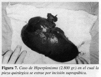 Caso de Hiperplenismo
