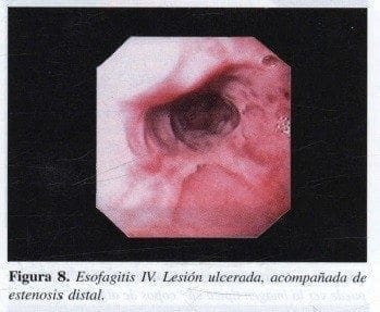 Esofagitis IV Esofagitis IV