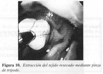 Extracción del tejido resecado mediante Pinza de Trípode Extracción del tejido resecado mediante Pinza de Trípode