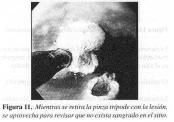 Mientras se retira la Pinza Trípode con la Lesión Mientras se retira la Pinza Trípode con la Lesión
