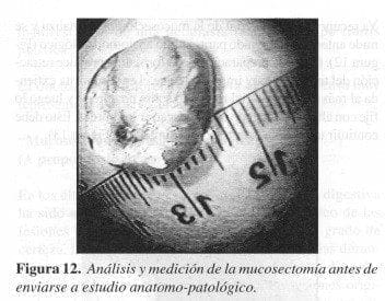 Análisis y medición de la Mucosectomía