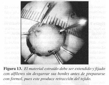 Produce Retracción del Tejido