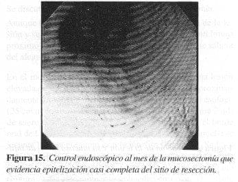 Control Endoscópico al mes de la Mucosectomía Control Endoscópico al mes de la Mucosectomía