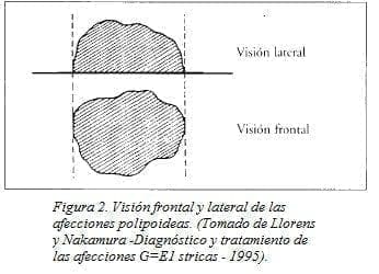 Visión Frontal y Lateral de las Afecciones Polipoideas Visión Frontal y Lateral de las Afecciones Polipoideas