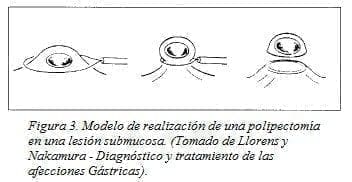 Modelo deRealización de una Polipectomía en una Lesión Submucosa Modelo deRealización de una Polipectomía en una Lesión Submucosa