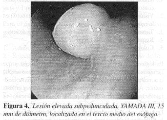Lesión Elevada Subpedunculada Lesión Elevada Subpedunculada