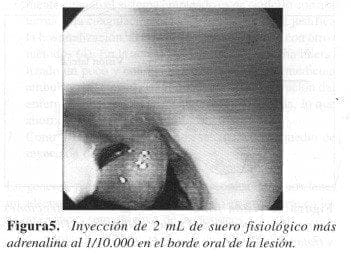 Inyección de 2 mL de Suero Fisiológico más Adrenalina Inyección de 2 mL de Suero Fisiológico más Adrenalina