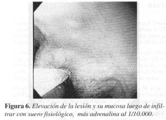 Elevación de la Lesión y su Mucosa Elevación de la Lesión y su Mucosa