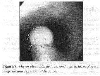 Mayor Elevación de la Lesión hacia la luz Esofágica Mayor Elevación de la Lesión hacia la luz Esofágica