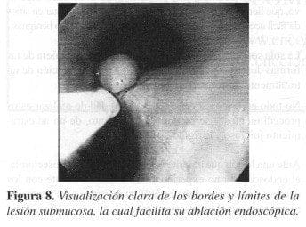 Visualización Clara de los Bordes y Límites de la Lesión Submucosa Visualización Clara de los Bordes y Límites de la Lesión Submucosa
