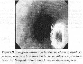 Polipectomía con un solo corte y corriente Mixta Polipectomía con un solo corte y corriente Mixta