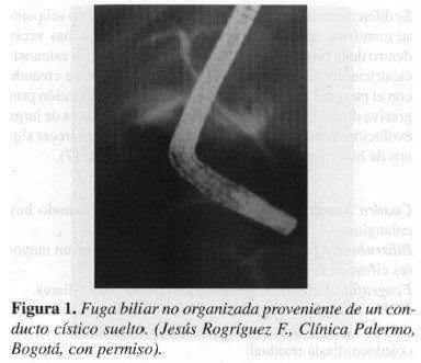 Fuga biliar no organizada proveniente de un Conducto Cístico Suelto Fuga biliar no organizada proveniente de un Conducto Cístico Suelto