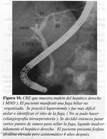 Muñón del Hepático Derecho Muñón del Hepático Derecho