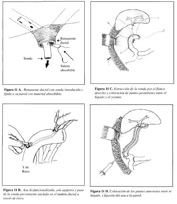 Accidentalidad Quirúrgica de las Vías Biliares, paso sondas Accidentalidad Quirúrgica de las Vías Biliares, paso sondas