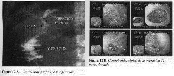 Accidentalidad Quirúrgica de las Vías Biliares, Control de la operación Accidentalidad Quirúrgica de las Vías Biliares, Control de la operación