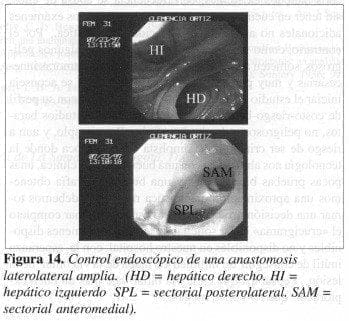 Control Endoscópico de una Anastomosis Laterolateral amplia Control Endoscópico de una Anastomosis Laterolateral amplia
