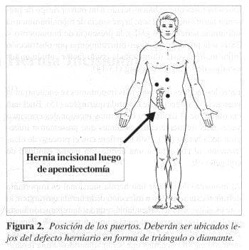 Hernia Incisional, Posición de los puertos Hernia Incisional, Posición de los puertos