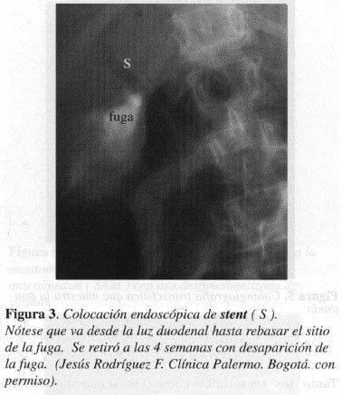 Colocación Endoscópica de Stent Colocación Endoscópica de Stent